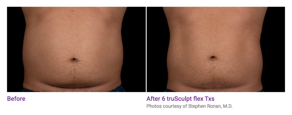 Trusculpt Flex Muscle Sculpting Seattle Lifted Beauty Wellness