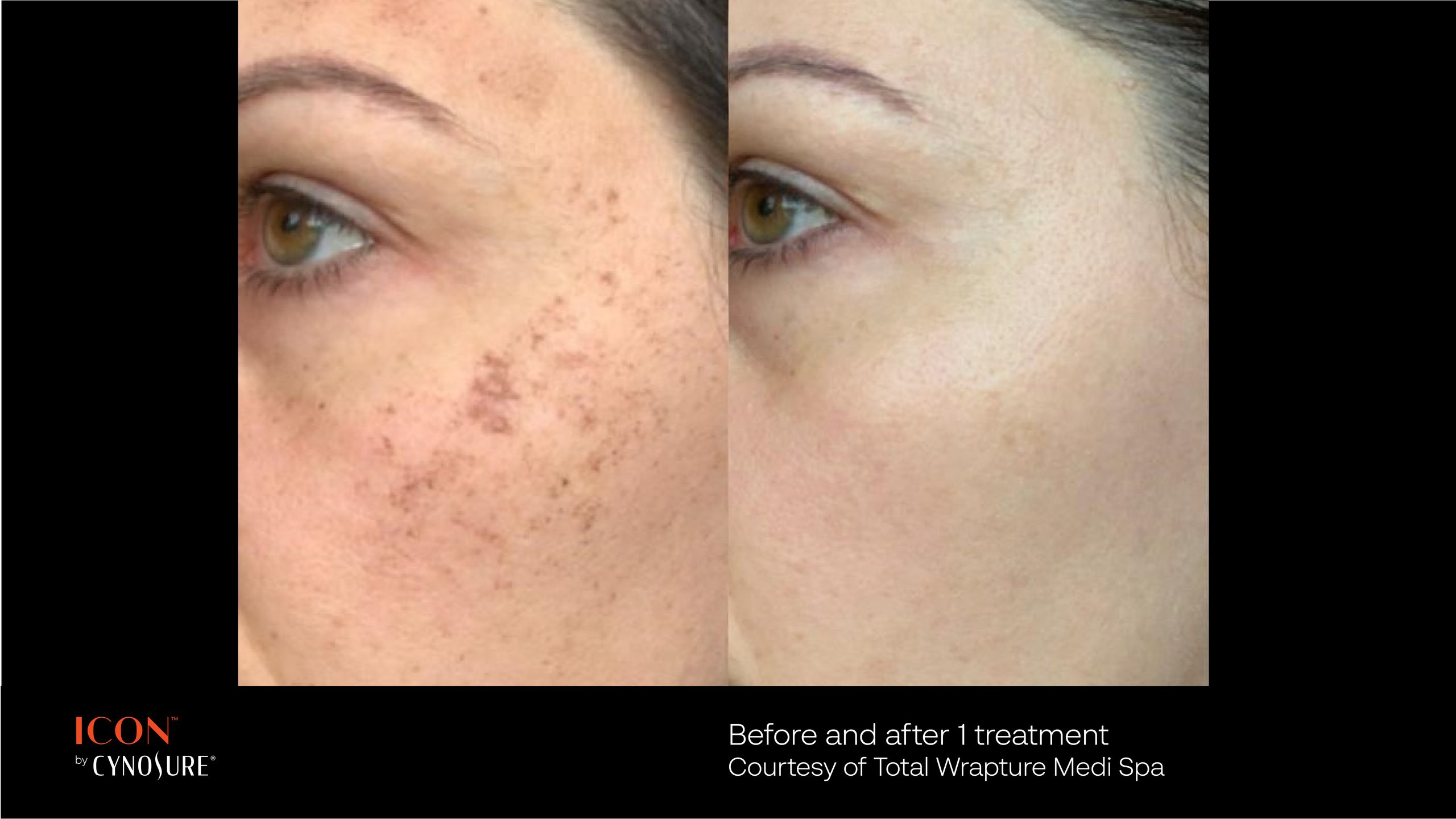 IPL before + after: brown pigment/sun damage