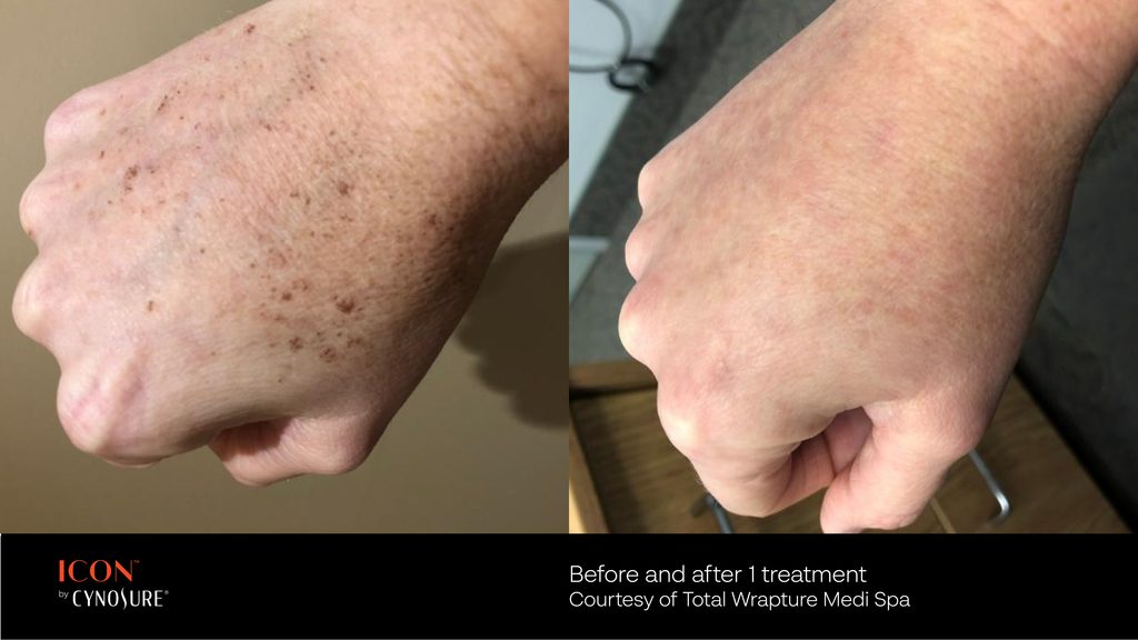 IPL before + after: brown pigment/sun damage