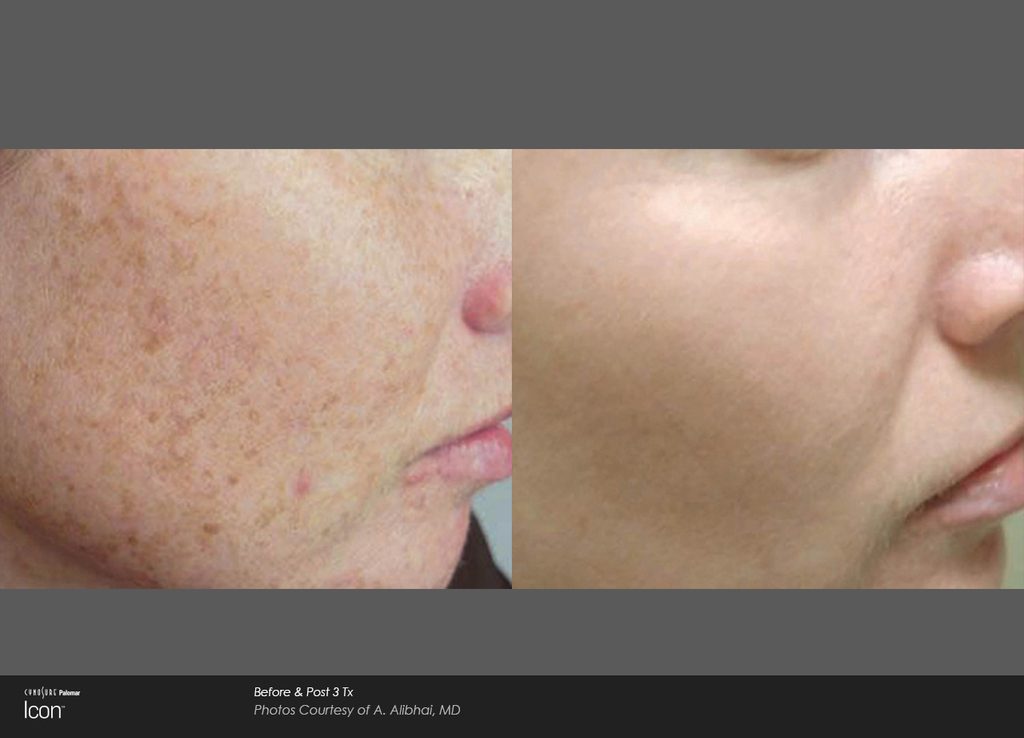 IPL before + afters: brown pigment/sun damage