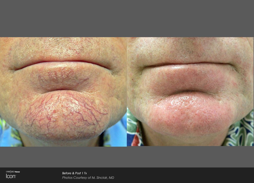 IPL before + after: facial redness/visible vessels