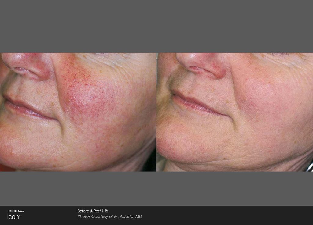 IPL before + after: facial redness/visible vessels